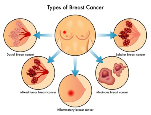 Cara mencegah kanser payudara